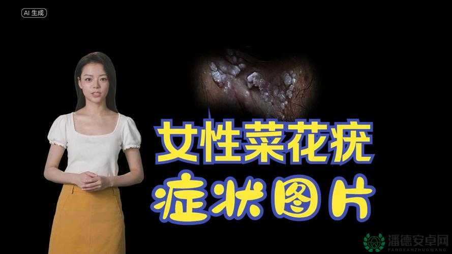 女性湿锐疣早期图片大揭秘：症状有哪些？如何自查与预防？需要注意的是，尖锐湿疣是一种性传播疾病，如有相关症状应及时就医，避免自行诊断和处理同时，网络上的图片可能存在不准确或误导的情况